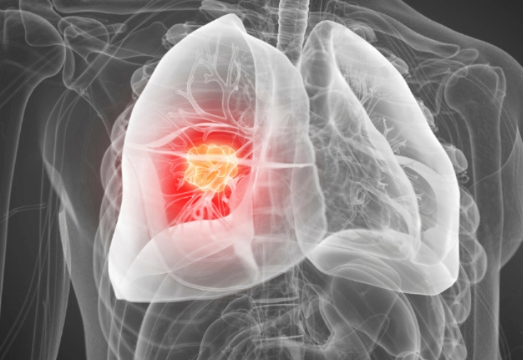 CRF-GO | Câncer de pulmão: novo tratamento aumenta tempo de vida de pacientes