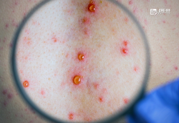 CRF-GO | SUS amplia uso da doxiciclina para prevenir sífilis e clamídia após exposição de risco