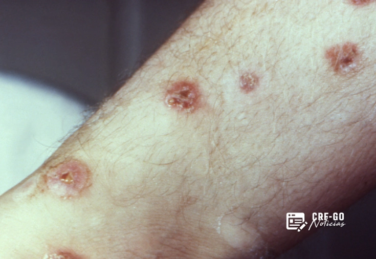 CRF-GO | Sífilis avança no Brasil e já é considerada epidemia persistente